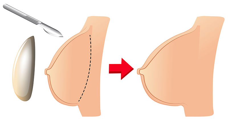 Breast Surgeon in Hadapsar Pune Dr. Abhijit Gotkhinde