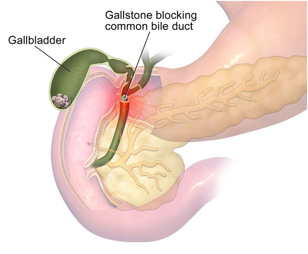Gallbladder Stone Removal Surgery (Cholecystectomy)