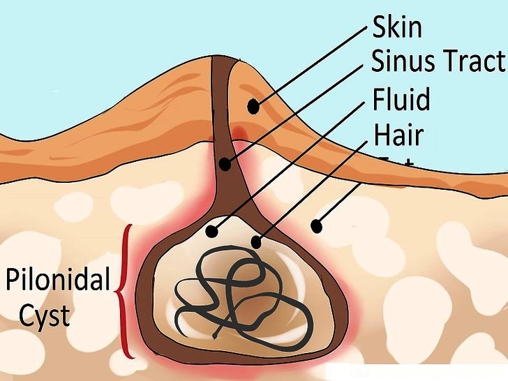 Pilonidal Sinus Disease (Pilonidal Cyst) - Dermatology Advisor