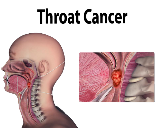 throat-cancer-6-unusual-symptoms-of-larynx-cancer-that-may-show-up-in