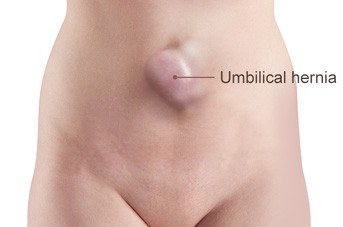 Umbilical Hernia Treatment & Surgery in Pune