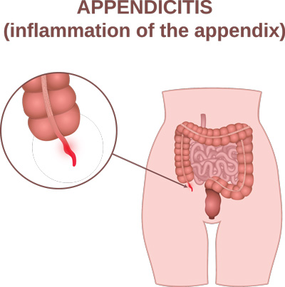 Best Appendicitis Treatment in Pune