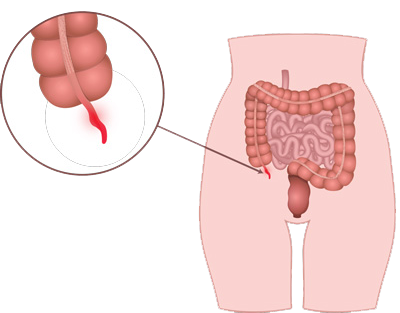 Appendicitis Treatment in Pune