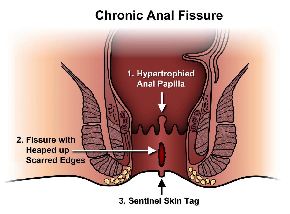 Fissure Specialist in Wanowrie, Fatima Nagar, Kondhwa, Undri, Manjri & Hadpsar