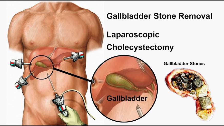 Gallbladder Stone Removal Surgery (Cholecystectomy) Hadpsar, Wanowrie Pune
