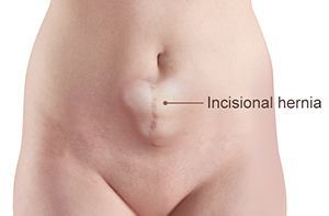 Incisional Hernia Epigastric Hernia Treatment & Surgery in Pune