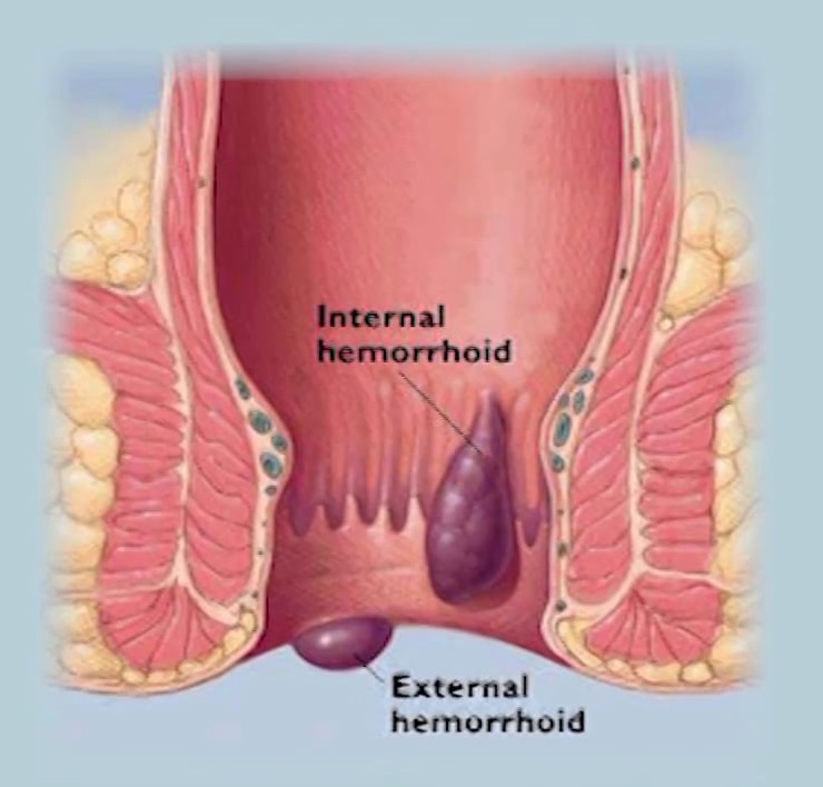 Best Hemorrhoid Treatment in Pune