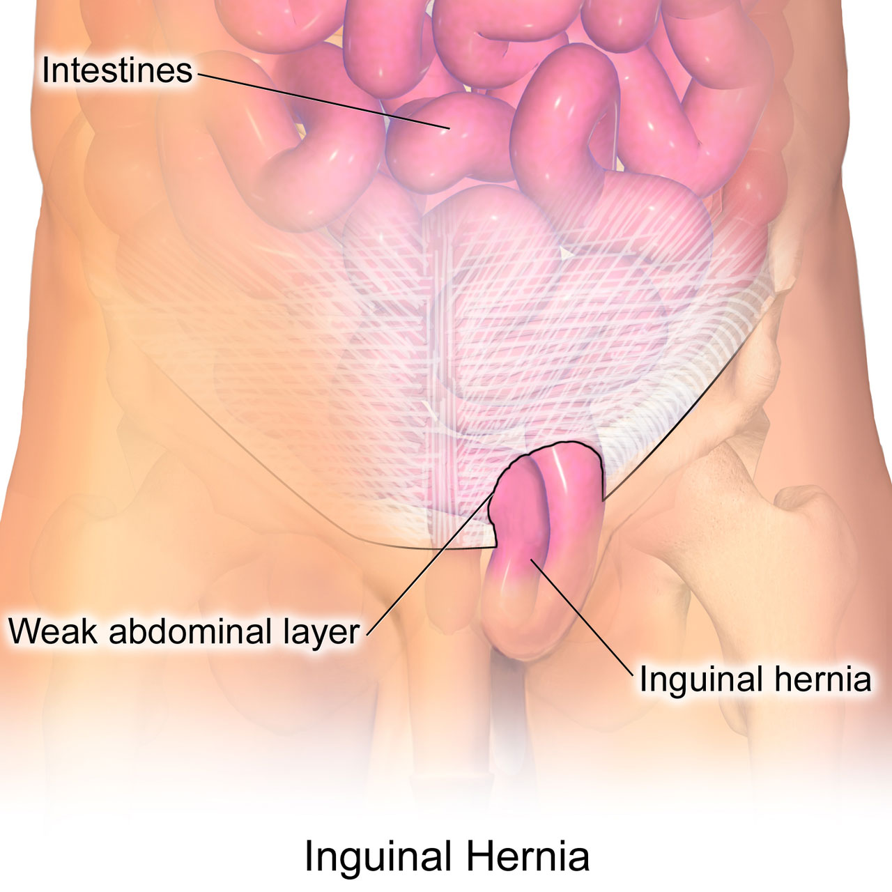 Inguinal Hernia Treatment & Surgery in Pune