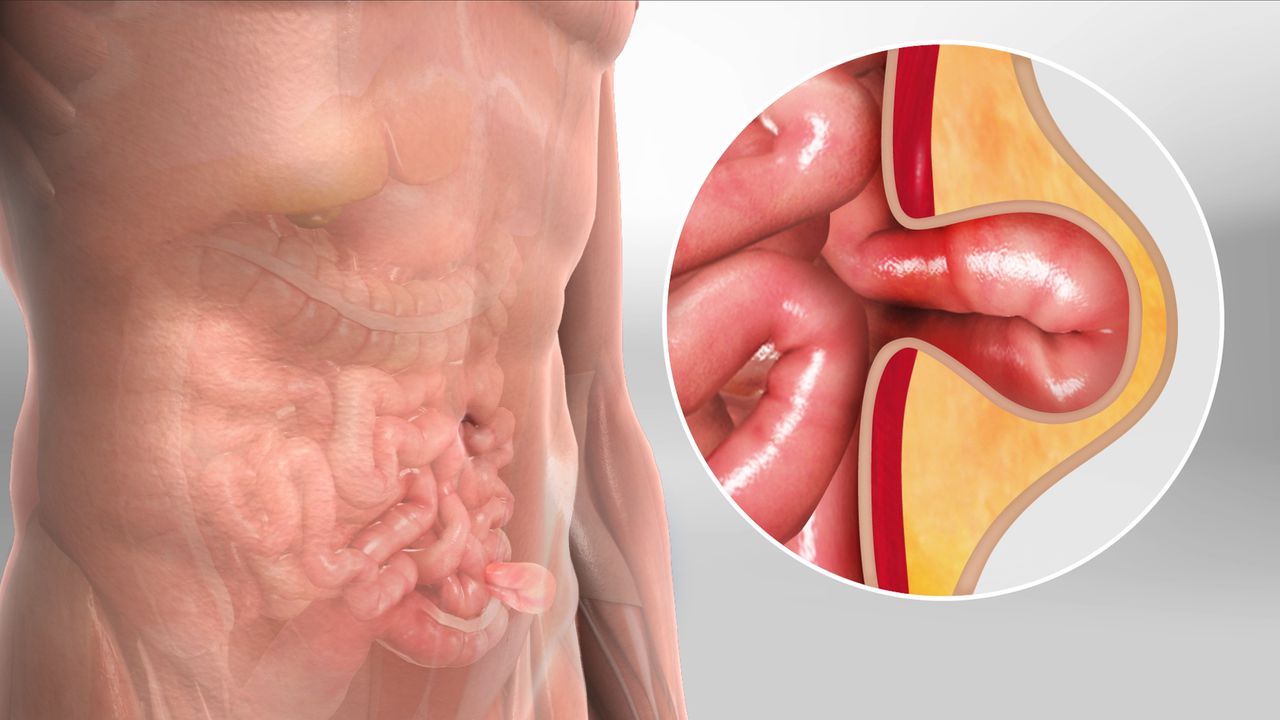 Laparoscopic Hernia Surgery in Pune